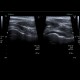 Reactive arthritis, arthritis in salmonellosis, salmonella: US - Ultrasound